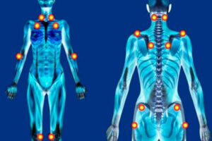 Fibromialgia