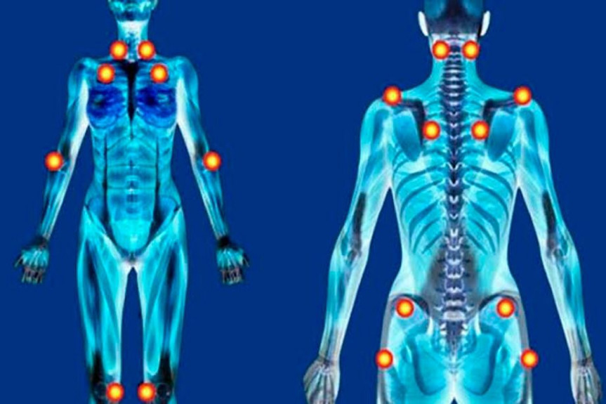 Fibromialgia